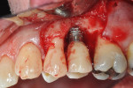 Figure 7. The surgical site after removal of granulomatous tissue and resection of the buccal threads of the implant.