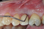 Figure 2. Patient presented with probing depths ranging from 8 mm to 10 mm with bleeding on probing and suppuration.