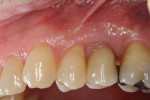 Figure 11. Twelve-month postoperative photograph showing 1-mm to 2-mm recession on the buccal of Nos. 12 and 14, which was esthetically acceptable to the patient.