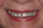 (Figure 1.) An unesthetic smile that was a result of years of wear and periodontal breakdown.