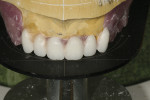 (Figure 3.) Esthetic parameters with Mondial teeth are easily verified using a Stratos mounting platform.