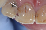 (Figure 10.) Lingual view after caries excavation.