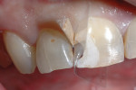 (Figure 12.) Isolation of tooth No. 8 in preparation for bonding and composite placement.