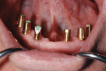 (Figure 5.) Temporary abutments/impression for temporary denture.