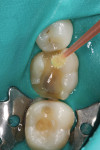 (Figure 3.) Adhesive was applied to the preparation on both the dentin and the enamel.