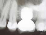 Figure 5  Radiograph of the restoration shown in Figure 4.