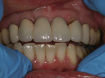 The patient expressed concerns about black triangles and her overall smile.