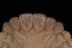 The second diagnostic wax-up shown from the lingual.