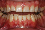 Severe attrition was evident on his anterior teeth and moderate attrition on his molars and first pre-molars.