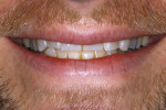 The patient shows a lack of anterior tooth display.