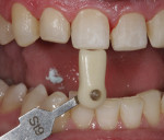 Tooth No. 9 was chosen by the patient as a reference for accetable aesthetics.