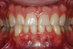 Pretreatment photographs suggested
tooth structure would not have to be replicated in ceramic.