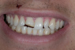 Figure 1   Patient presented with a fractured right central incisor.