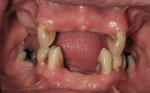 Figure 4  Structurally compromised teeth from large active carious lesions.
