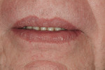 Figure 5  Lips in repose showing excessive display of lower anterior teeth.