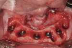 Figure 7  Surgical site of implant placement.