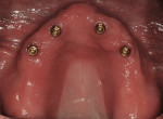 Figure 17  Upper implants with locator attachments for maxillary denture retention.