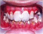 Figure 1  Intraoral view at first visit. Severe gingival inflammation and extensive tooth destruction can be seen.