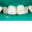Excellence in Full Denture Technology Webinar Thumbnail