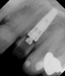Figure 11 Radiograph of immediate implant in fresh extraction socket and provisional properly seated. Note the lucent appearance of the PEEK temporary abutment at the implant–abutment interface.