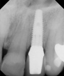 Figure 18 Radiograph taken 5 years after cementation of the final crown. Note sustained crestal bone levels despite a platform-shifting implant system.