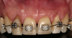 Figure 3  Beginning of orthodontic treatment. Note that anchorage was achieved by maxillary anterior teeth.