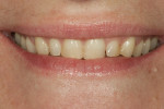 Figure 2 Full smile close-up, pre-treatment.