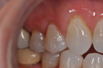 2-mm notch in the neck of the tooth (on Nos. 5 and 6) repaired with N'Durance Dimer Flow.