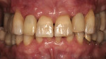 Figure 9  Implant-supported provisional restorations on implants No. 7 and No. 10.