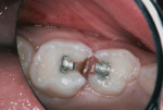 Figure 2 Fractured amalgams with caries at the margins.