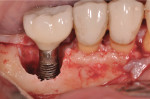Figure 4 Implant surface after debridement with piezoelectric scaler.