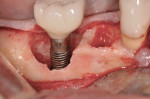 Figure 6 Clinical appearance of implant surface after antiseptic chemical treatment using citric acid.