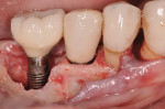 Figure 8 Immediate provisional restoration No 29 implant.