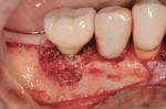 Figure 12 PRP/graft complace placed into peri-implant defect.