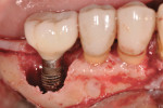 Figure 3 Pre-debrided implant surface, clinical view after flap elevation and debridement.