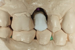 Figure 7 The facial incisal edge was layered with veneering ceramic.