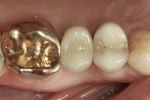Figure 18 Occlusal view of the hybrid abutment restoration after sealing of the access hole.