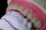 The wax behind the upper canine is an indentation of the opposing canine for stability and anterior stop.