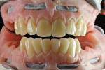 When reconstructing the upper and lower jaw, it is recommended to fabricate one arch at a time to completion.
