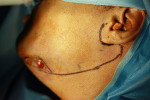 Figure 10  Outline exemplifying incision site.