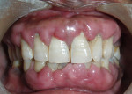 Figure 1  Preoperative photograph of the patient showing generalized gingival enlargement.