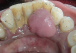 Figure 2  Photograph showing nodular growth on lingual surface of mandibular incisors.