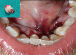 Figure 3  Postoperative photograph of mandibular incisors after excision of growth and suturing. Inset shows the excised growth.