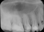 Pre-operative radiograph of tooth No. 4.