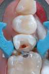Isolation of the preparation with Palodent Plus.