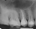 Final radiograph showing the completed root canal therapy and final composite restoration.