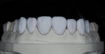 Enamel porcelains are layered overtop internal dentin porcelains.