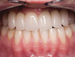 Figure 13 Once tried in, the value of the upper is noticeably lower than the natural mandibular anteriors.