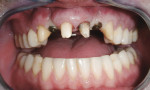 Figure 10 Implants were placed to restore teeth No. 7 and No. 10.