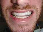 Figure 3 The patient desired a longer, fuller smile with a normal overbite.